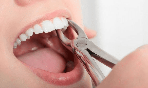 Những điều bạn nên lưu ý khi trị sâu răng